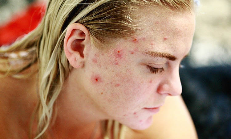 Consejos y tratamientos para vencer el acné